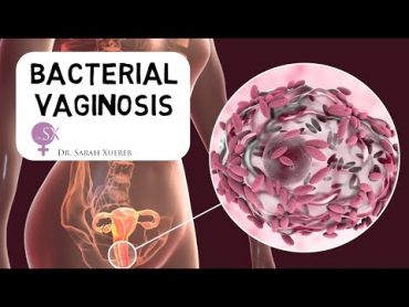 Bacterial Vaginosis