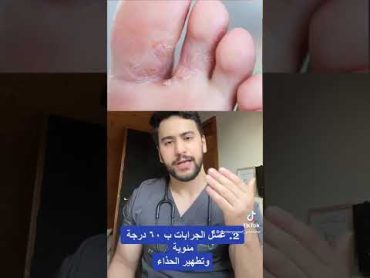 علاج سهل وفعال لفطريات القدم🤩  دكتور يوسف