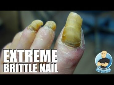 HIGH RISK NAIL CUTTING OF LONG TOENAILS  4 YEARS NOT CUT!!!