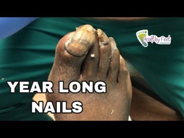 Year Old Long Toenails!