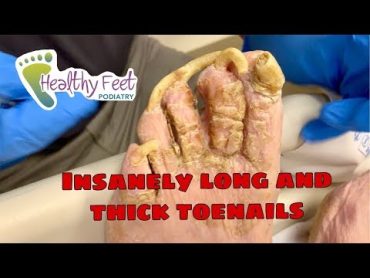 CUTTING INSANELY LONG TOENAILS!