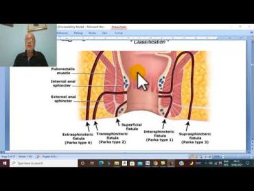 Anal Disorders in Arabic 8  (Anal Fistula , parts 2 ) , by Dr. Wahdan