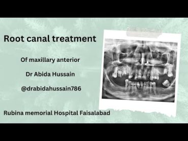 Root canal preparation of canals dental dentistry smile drabidahussain786@drabidahussain786