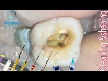 Root canal Cleaning and Shaping Using Rotary Files