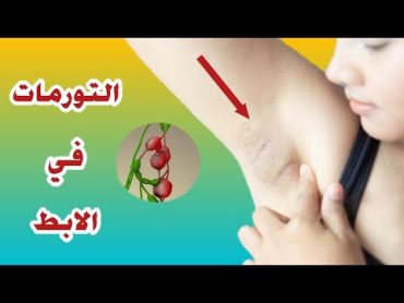 الغدد اللمفاوية في الابط أسبابها و لماذا يجب الحذر منها ؟ تورمات الإبط