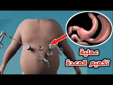 شاهد كيف يتم اجراء عملية تكميم المعدة Sleeve gastrectomy and gastric bypass surgery