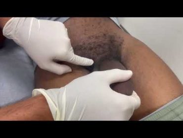 Deflating A Penile Prosthesis