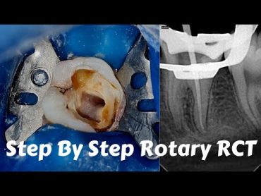 Live Steps Root Canal Rotary Protaper Endodontic Procedure  ACP, BMP, obturation, irrigation