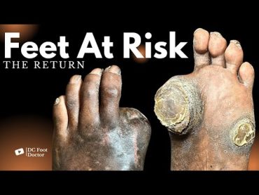 Feet At Risk: The Return