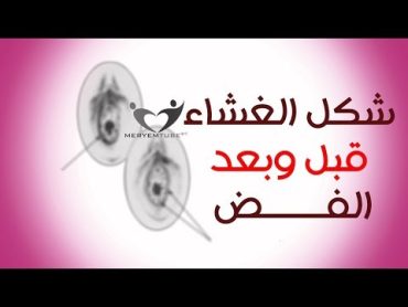 ما الفرق بين الغشاء السليم وغير السليم