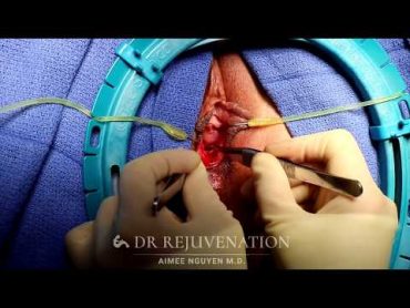 How To Become A VIRGIN Again  Hymenoplasty