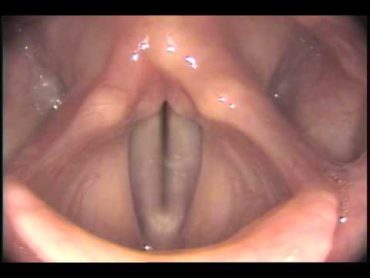 Stroboscopy: Rigid: Normal female vocal cords  glide up