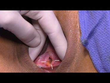 Broken Hymen Repair! Hymenoplasty, Revirgination, Like a Virgin