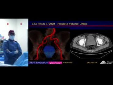 Transradial Prostate Artery Embolization (PAE) for Symptomatic BPH