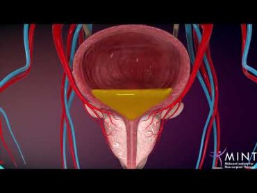 Prostate Artery Embolization (PAE) video