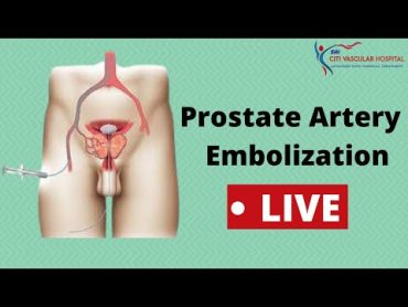 Live Prostatic Artery Embolization (PAE) Procedure Video for Enlarged Prostate Explained