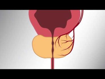 Prostatic Artery Embolization (PAE) Patient Video