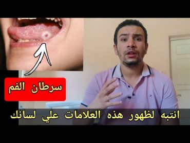 4 اعراض علي اللسان تشبه سرطان الفم