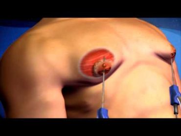 Male Breast Reduction Surgery  3D Medical Animation  ABP ©