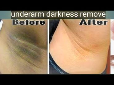 dark underarms removal at home easly browsefeatures search youtube @RABIASKINANDHEALTHCARE