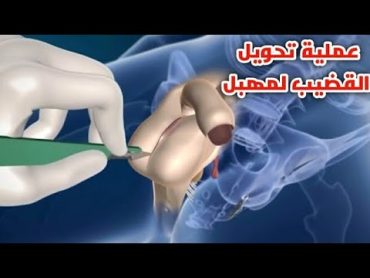 شاهد عمليه تحويل العضو الزكري ل عضو أنثويجراحه تحول الرجل لأمرأه Surgery to convert penis to vagina