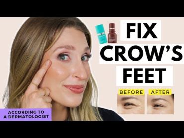 Treatments for Crow&39;s Feet That WORK  Fix Eye Wrinkles  Dr. Sam Ellis