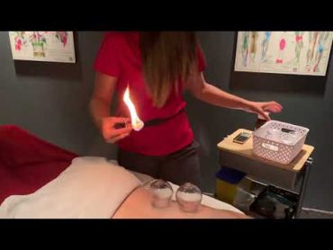 Fire Cupping at Barrie Sports Medicine