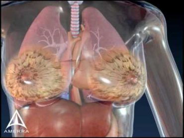 Breast Cancer Biopsy  3D Medical Animation