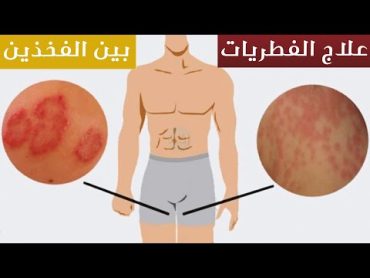 علاج الفطريات بين الفخذين