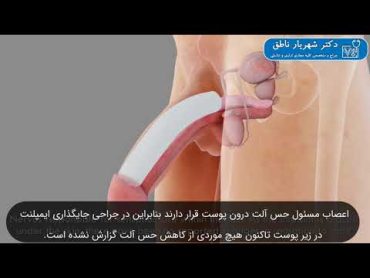 جراحی افزایش سایز آلت (پروتز آلت)