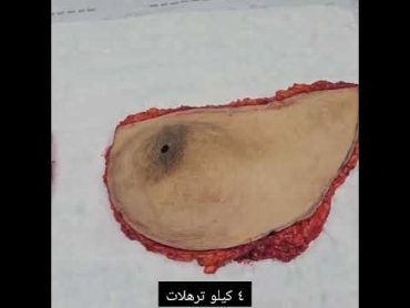 شد الصدر العرضي في حالة ترهلات شديدة ف الصدر عند الرجال gynecomastia