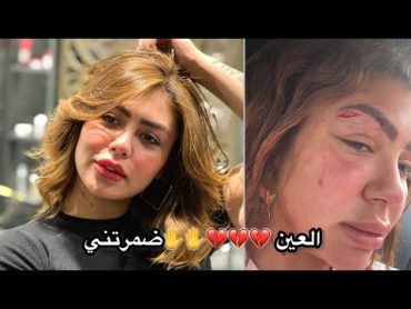 العين فلقت الحجر 😠💔اتعورت في وشي 14 غرذه😡