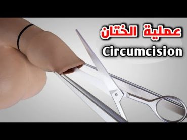 شاهد كيف تتم عملية ختنان الذكور(الطهارة) Circumcisionmale