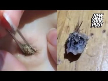 Girl removes gigantic, hairy blackhead from her belly button