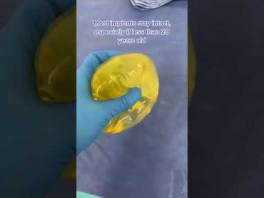 Why Are These 18 Year Old Breast Implants Slightly Yellow? shorts breastimplants