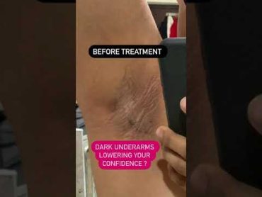 Dark underarms killing your confidence  Dr Ashima Goel Dermatologist ChandigarhMohali shorts