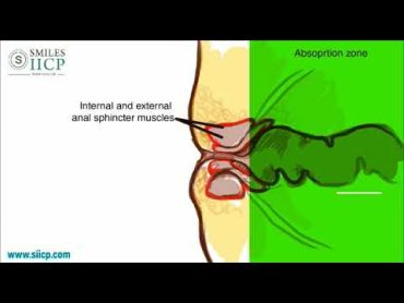 Learn How To Insert Anal Suppository  SMILES Gastroenterology