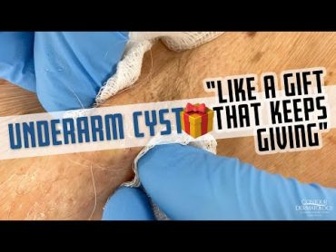 This Underarm Cyst is Like A Gift That Keeps Giving