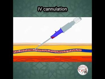 💉 INTRAVENOUS (IV) CANNULATION ANIMATION