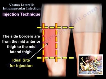 Vastus Lateralis Intramuscular Injection  Everything You Need To Know  Dr. Nabil Ebraheim