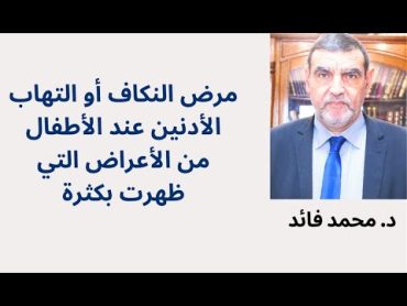 الدكتور محمد فائد  العلاج الطبيعي لمرض النكاف عند الأطفال (التهاب الأدنين)