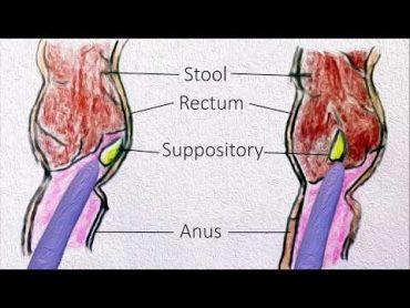 Rectal Suppositories  How to use them?