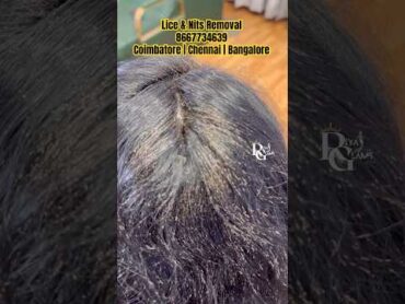 Lice removal/lice/how to treat lice from hair/lice treatment in parlour/lice eggs removal/💯% result