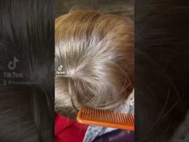 Visible Lice Eggs on Little Boy lice licetreatment oklahomacity licecheck