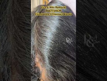 How to treat lice & nits/how to remove lice from hair/lice treatment in parlour/lice removal/lice