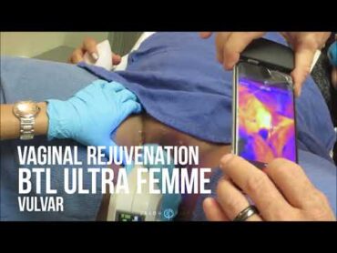 BTL ULTRA Femme 360 for VAGINAL TIGHTENING and REJUVENATION of the LABIA  Dr. Jason Emer