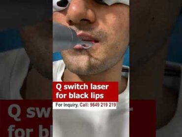 Q switch laser for black lips shorts  q switch laser Q switch laser black lips skinaaclinic