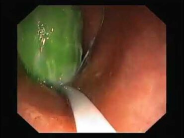 استخراج خياره من داخل الشرج والمستقيم،  شاب عمره ٣٢ سنه، Colonoscopy 🥒🥒cucumber، اشترك في القناه