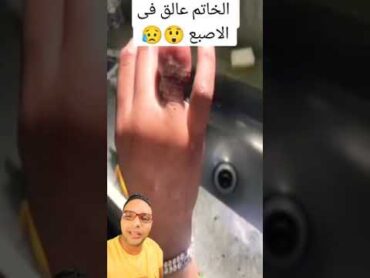 مش هتصدق عملوا ايه عند إزالة الخاتم العالق في الإصبع  UNBELIEVABLE RING STUCK ON FINGER  shorts