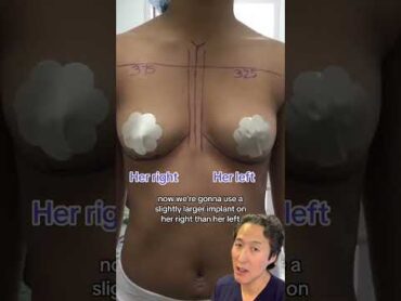 Breast Augmentation A to a C Cup Before and After! breastaugmentationsurgery